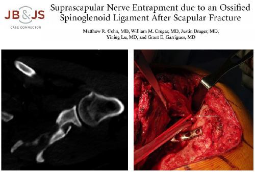 >This rare case illustrates how an ossified spinoglenoid ligament can cause suprascapular nerve entrapment.