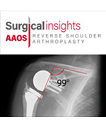 Surgical Insights: Reverse Shoulder Arthroplasty