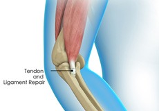 Elbow Tendon and Ligament Repair