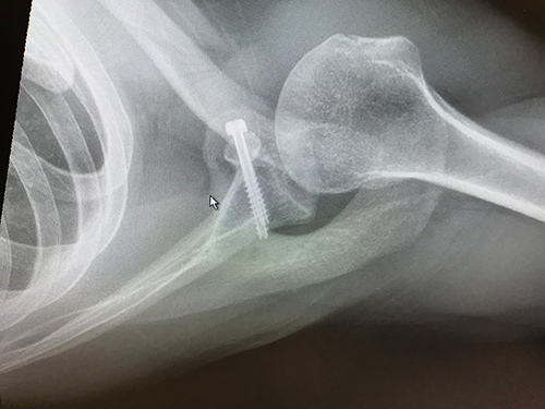 Glenoid bone loss influences