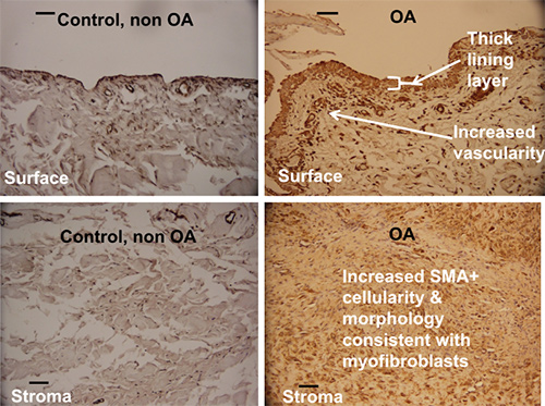 Myofibroblasts Capsule