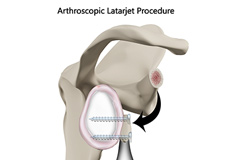 Arthroscopic Latarjet Procedure