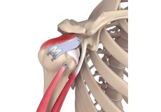 Arthroscopic Superior Capsular Reconstruction