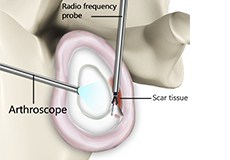 Capsular Release