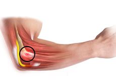 Common Extensor Tendon Origin Repair