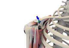 Distal Clavicle Excision