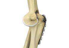 Elbow Fracture Reconstruction
