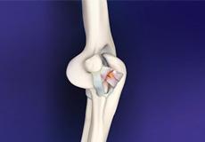 Elbow Ligament Reconstruction