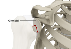 Glenoid Fractures