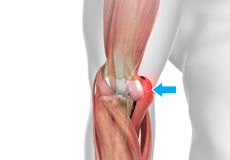 Hyperextension Injury of the Elbow