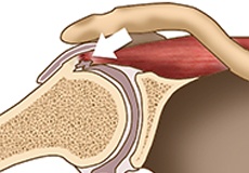 Internal Impingement of the Shoulder