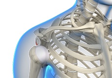 Multidirectional Instability of the Shoulder