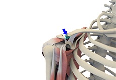 Mumford Distal Clavicle Excision