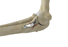 ORIF of Coronoid Fractures