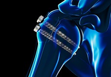 ORIF of Humerus Fractures