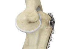 ORIF of Olecranon Fractures