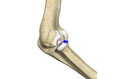 Osteochondritis Dissecans of Elbow