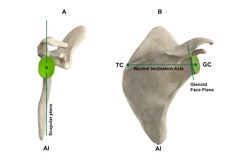 Patient Specific Planning and Instrumentation