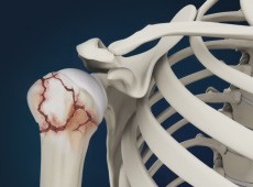 Shoulder Fracture Care