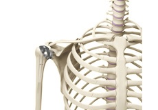 Shoulder Joint Replacement