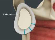 Shoulder Labrum Reconstruction