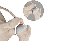 Subacromial Decompression