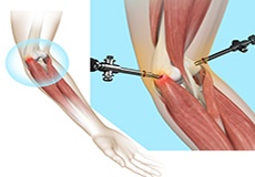 Tennis Elbow Surgery